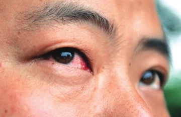 崇州：28个娃娃眼红发烧住院 疑因同一泳池游泳造成