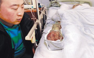 妻子为消气咬丈夫胳膊 致其患心肌炎险丧命