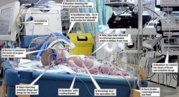 英国医生将婴儿冷冻4天实施心脏手术