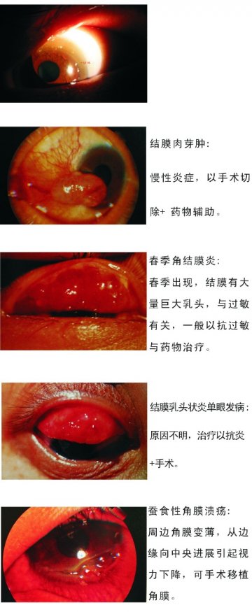 结膜肉芽肿、春季角结膜炎、结膜乳头状炎单眼发病、蚕食性角膜溃疡