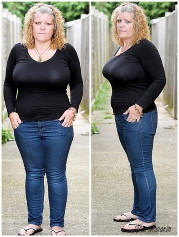 英母亲因“巨乳”影响生活欲手术