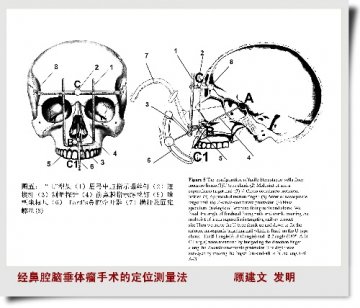 经鼻腔行脑垂体瘤切除的测量定位