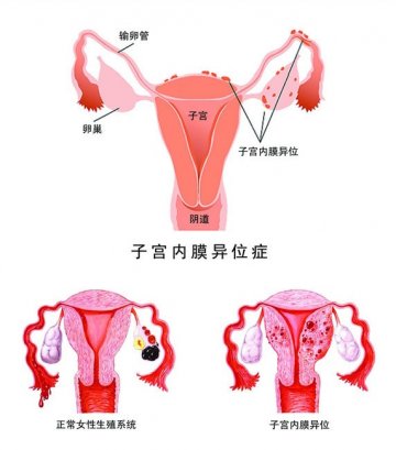 军医提醒：警惕子宫内膜“出逃”