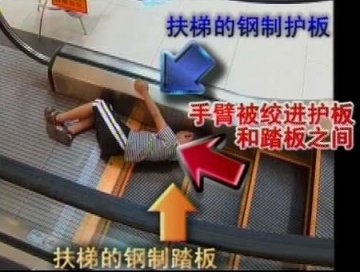 5岁男孩手臂绞进商场扶梯被迫截肢
