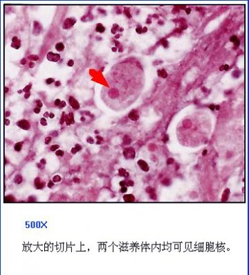 阿米巴痢疾病人肠病理切片（放大500倍）