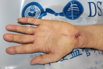 武警总医院神经血管外科采用腕管镜技术治疗腕管综合征