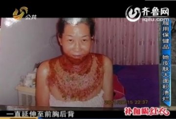 “完美”产品用后不再完美 女子用后身体腐烂