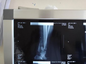 骨髓炎让我的左腿比右腿短6公分