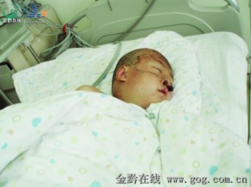 8岁男孩遭马蜂“追杀” 多器官衰竭靠换血保命