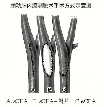颈动脉内膜剥脱术术式选择要点