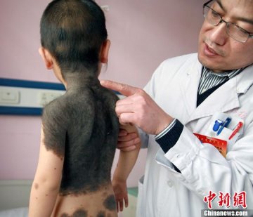 三岁男童患罕见巨型黑毛痣病 半身黑毛覆体
