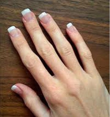 英国妇女网上晒美甲被发现患恶疾捡回性命