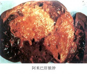 阿米巴肝脓肿病理标本