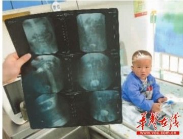 2名儿童一共长有7个肾就医 2人同年同月同日生