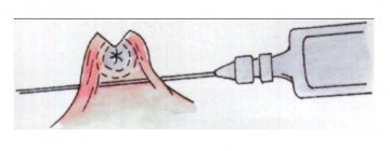 钳穿输精管结扎术