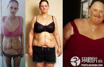 盘点：惨不忍睹的减肥后遗症