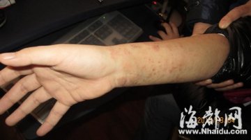 12岁女孩患怪异皮肤病 全身长硬皮奇痒难耐