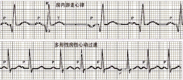 房内游走心律和多形性房性心动过速