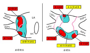 房颤治疗的困惑与希望