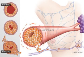 乳腺癌发病阶段