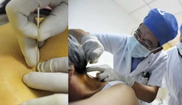 铍（pí）针治疗颈肩腰腿痛