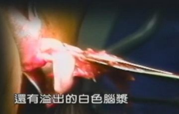 实拍少女人流全过程
