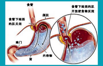 剖析胃-食管反流病