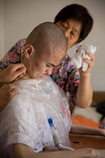 庞贝氏病患者带着呼吸机的生活