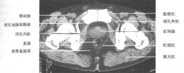 正常男性盆腔CT（2）
