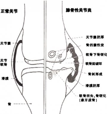 秋冬时节 关爱关节