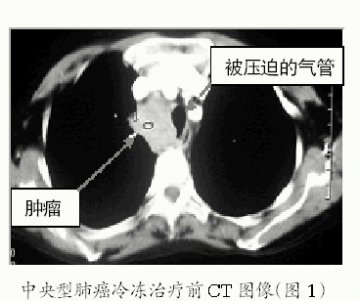 创新治疗手段 “冻死”肺癌细胞——访中央型肺癌治疗专家、广州复大肿瘤医院牛立志博士 深圳电台记者 胡晓梅