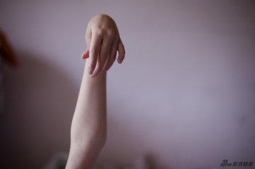 实拍尼曼皮克氏病患者的生活