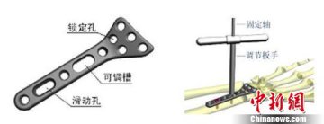 骨科专家破解手腕骨折复位难题 将申请国际专利