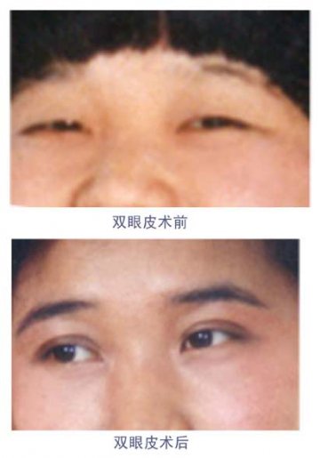 双眼皮手术前后对比图