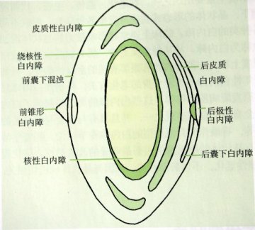 白内障图