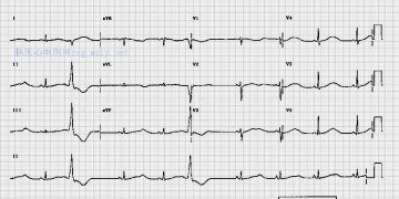 长QT间期 Long QT interval