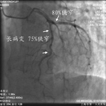 经桡动脉处理起源异常的RCA闭塞病变并冠状动脉瘘