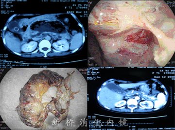 新桥医院消化科采用新方法治疗腹腔脓肿