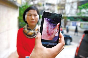 消费者在广州曙光花4万整容后脸部化脓