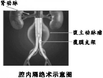 腹主动脉瘤需手术