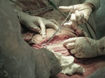 人体探秘：实拍剖腹产震撼生产过程