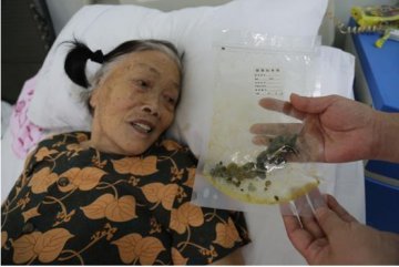黄石市爱康医院胸腹微创外科成功为86岁胆石症患者实施手术