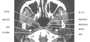 正常鼻咽鼻窦CT（6）
