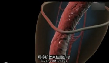医学解读：男子腿绑香肠冒充阳物为何丧命