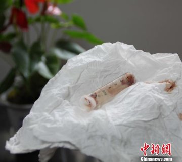 宜昌一患者术后吐出塑料针筒 院方称还在调查