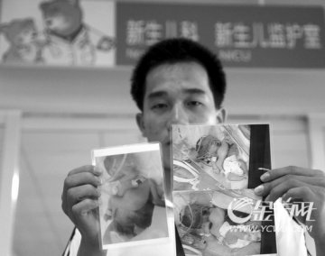 罕见连体婴胸口长双腿