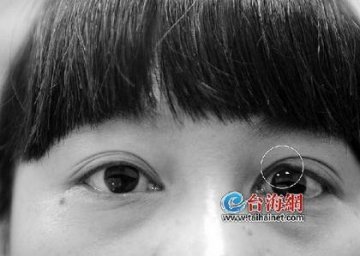 女子手术后变成三角眼 医院称是手术并发症