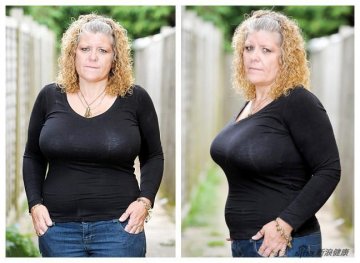 英母亲因“巨乳”影响生活欲手术