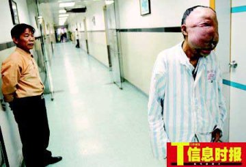广东象面人手术后出院回家过年