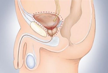 膀胱癌防治完全手册
